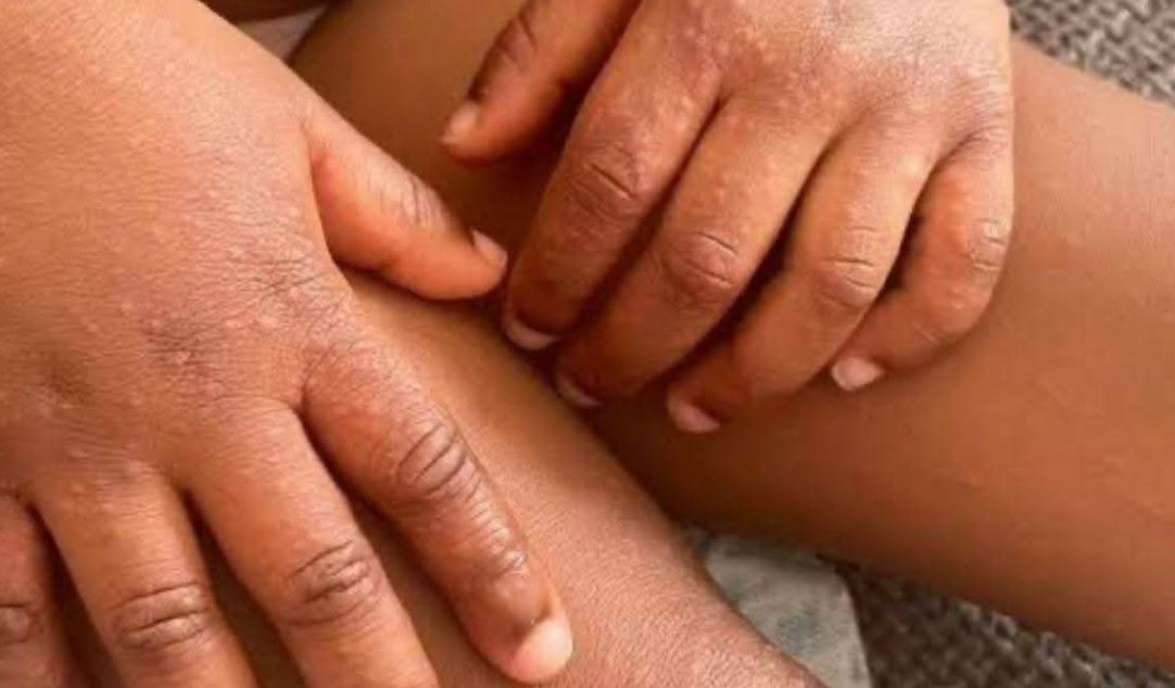 Bulawayo Grapples with Hand, Foot, and Mouth Disease Outbreak